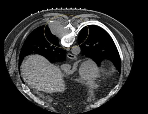 Ct Guided Core Needle Biopsy Of The 5 6×3 5×3 2 Cm Mass Lesion Of The Download Scientific