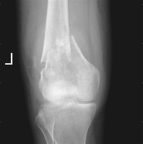 Osteosarcoma X Ray Wikidoc