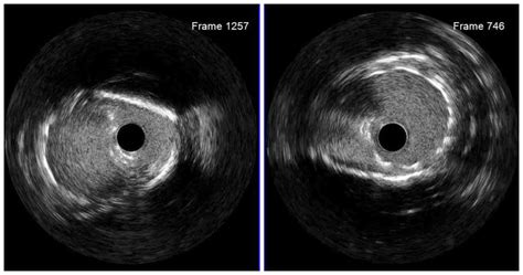 Case 7: Proximal LAD stent underexpansion and malapposition ...