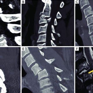 Ao Spine Subaxial Fracture Classification Score A Compression