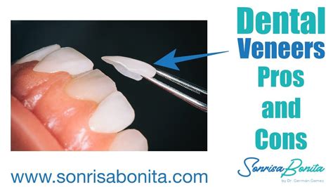 Dental Veneers Pros And Cons Youtube