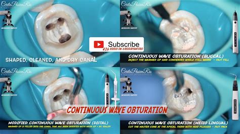 Modified Continuous Wave Obturation Technique Bioceramic Sealer Fast