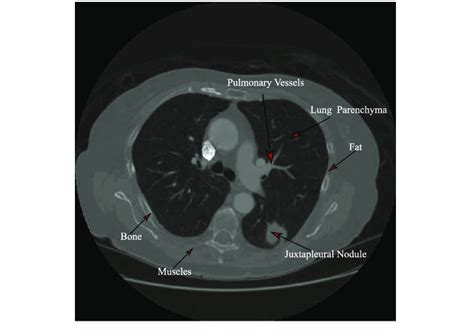 Representative Slice Of A CT Scan Showing Anatomical Structures