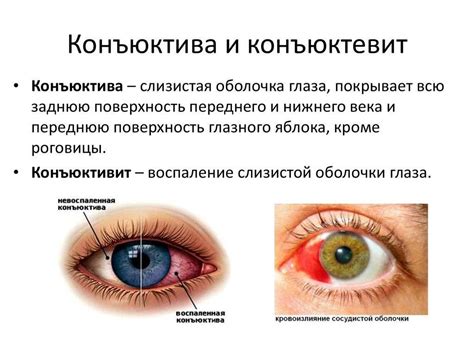 Терапия конъюнктивита