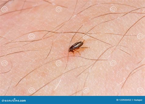 Flea On Human Skin Stock Photography 96103256