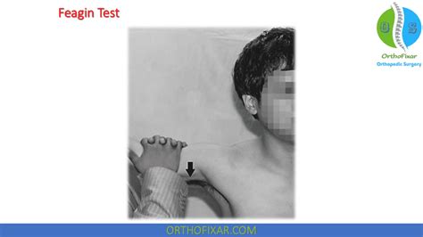 Sulcus Sign Inferior Shoulder Instability Orthofixar 2024