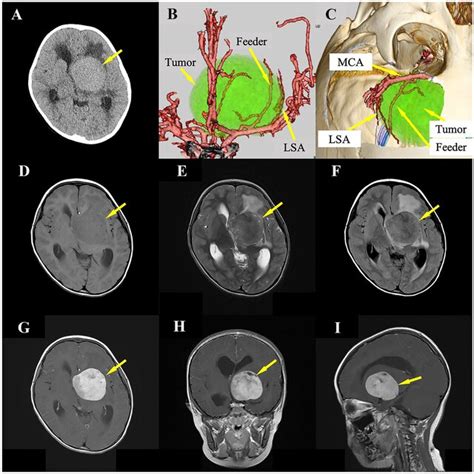 Preoperative Computed Tomography Ct And Ct Angiography Cta The