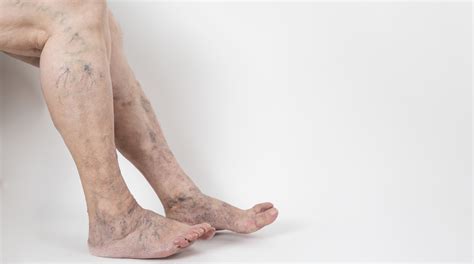 Why Do Varicose Veins Develop Beverly Hills Heart And Vascular Center