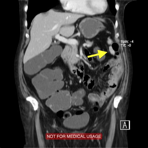 Splenosis Image