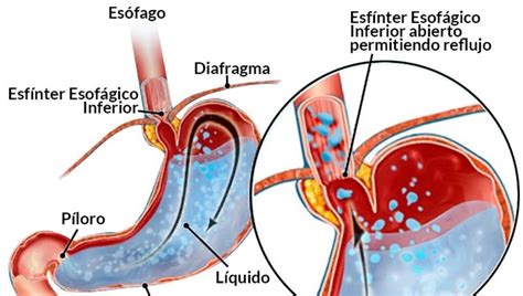 Enfermedad Por Reflujo Gastroesof Gico Mind Map