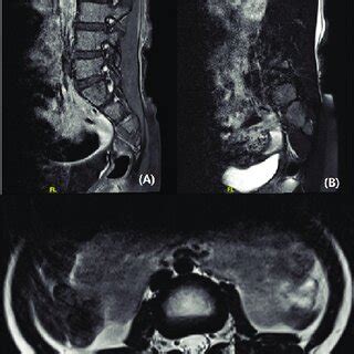 Magnetic Resonance Imaging Mri Of The Lumbar Spine Sagittal