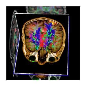 Brain Tumour Photograph By Simon Fraser Science Photo Library Pixels