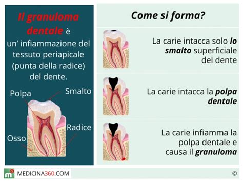 Granuloma Dentale Sintomi Cause Rischi Trattamenti E Rimedi Naturali