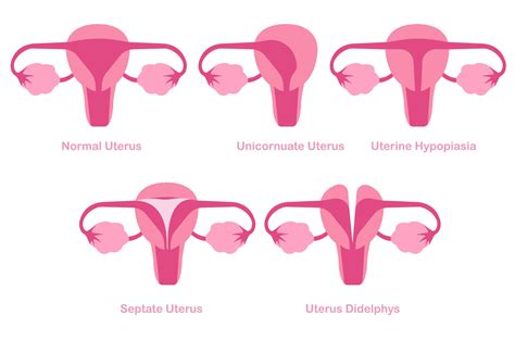 Congenital Mullerian Anomalies Or Uterine Abnormalities Concept