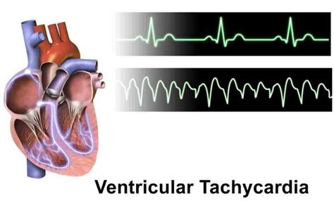 Ventricular Tachycardia Causes Symptoms And Treatment