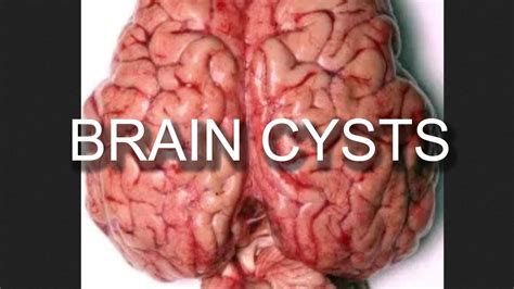Epidermoid Cyst Brain Epidermoid Brain Tumor Society Brain Tumor Cancer