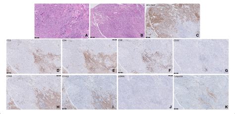 Patient 2 Photomicrograph Of The Incisional Biopsy Hematoxylin