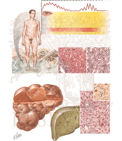 Spirochetal Infections Weils Disease Syphilis