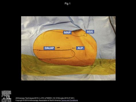 Creating And Closing The T Capsulotomy For Improved Visualization