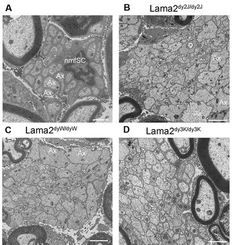 Frontiers Lama Neuropathies Human Findings And Pathomechanisms From