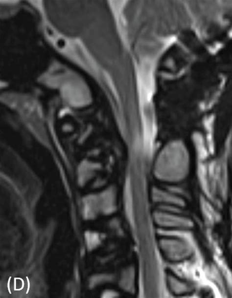 A B Lateral Radiographs Of The Cervical Spine In Flexion And