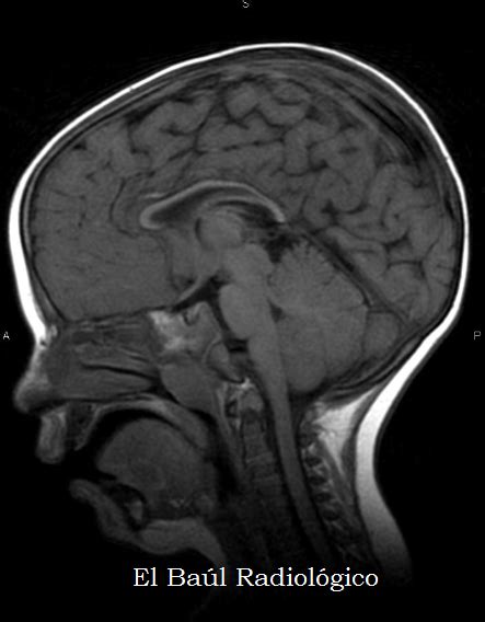 El Ba L Radiol Gico Atrofia Del Cuerpo Calloso Hallazgos En Tc E Irm