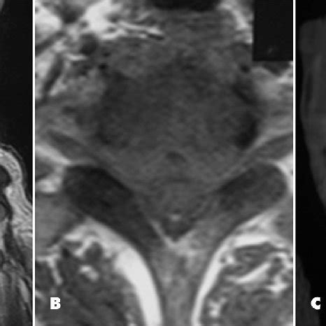 Figure Preoperative Sagittal A And Axial B T2 Weighted Magnetic