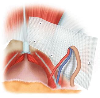 Laparoscopic Total Extra Peritoneal TEP Inguinal Hernia Repair