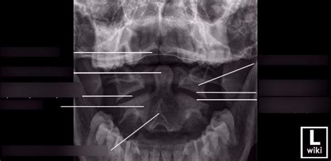 Radr 1411 Ap Open Mouth X Ray Anatomy Diagram Quizlet