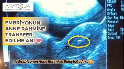 Embriyonun Anne Rahmine Transfer An Embriyo Transferi Youtube