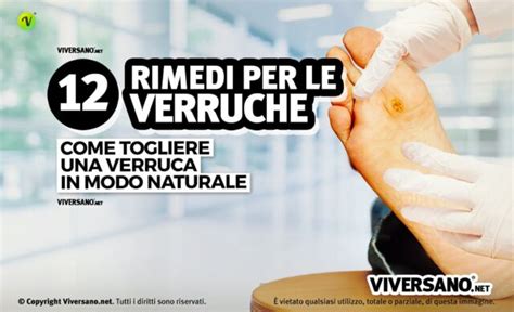 Emorroidi i rimedi naturali più utili ed efficaci per curarle