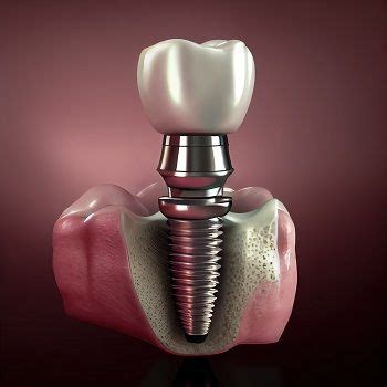 The Dental Implant Procedure What To Expect During Treatment