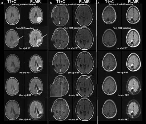 Examples Of Pseudoprogression A Example Of Early Enhancing PsP