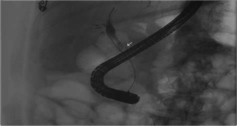 Cholangioscopy As A Rescue For A Post Cholecystectomy Adherent Stone