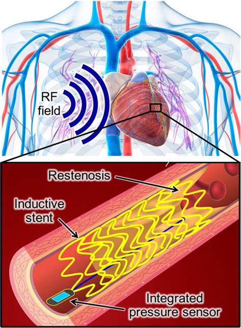 Conceptual Diagram Of Wireless Sensing Of Vascular Conditions Through