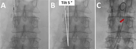 Successful Endovascular Retrieval Of An Inferior Vena Cava Filter