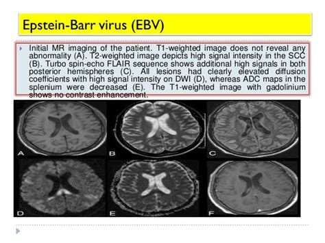 Imaging Of Viral Encephalitis