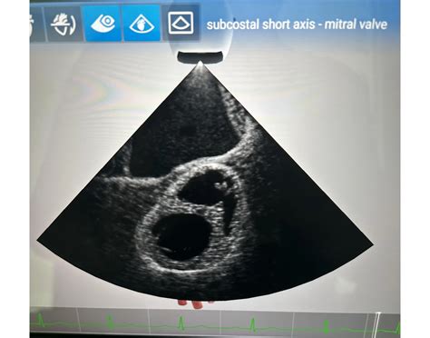 Subcostal Short Axis Mitral Valve Quiz
