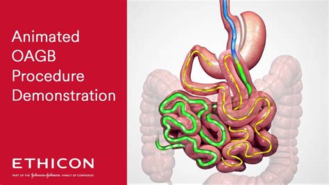 One Anastomosis Gastric Bypass OAGB Animated Patient Education Video