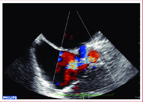 2D Transesophageal Echocardiography Mid Esophageal View At 65 With