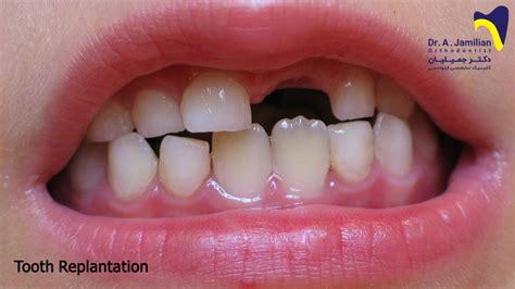 Tooth Replantation Dr Jamilian