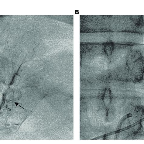 Superselective Adrenal Arterial Embolization A Angiography Of The