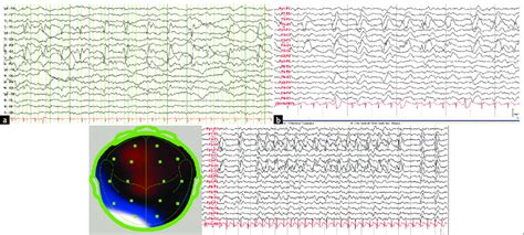 Eeg Epoch Is Consistent With Hz Lateralized Periodic Sharp Waves Over