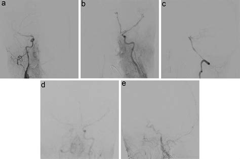 Persistence Of Intracranial Blood Flow On Cerebral Angiography In Brain