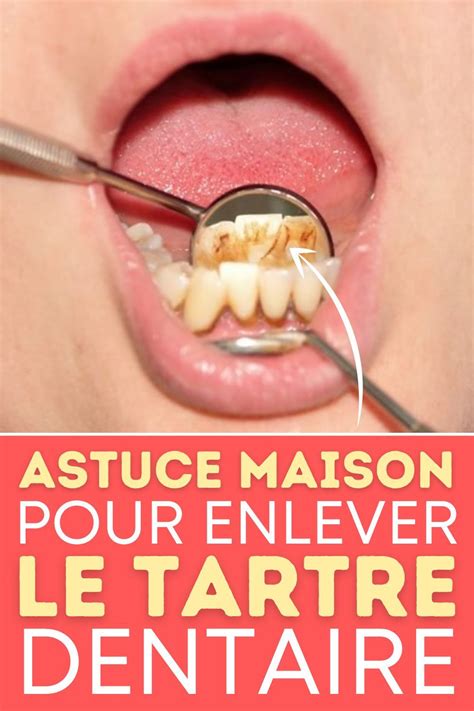 Astuce maison pour enlever le tartre dentaire soi même Tartre