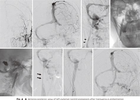 Figure From Transverse Sigmoid Sinus Dural Arteriovenous Fistula With