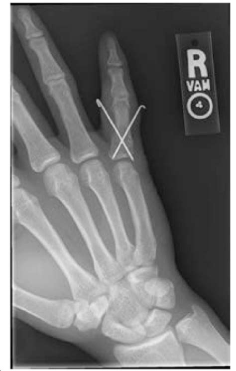 Fifth Proximal Phalanx Fracture Hand