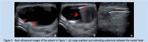 Figure From Treatment Of Popliteal Baker Cysts With Ultrasound