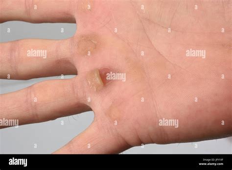 Detail Of Calluses On The Palm Stock Photo Alamy