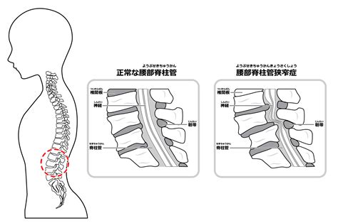 腰部脊柱管狭窄症 安城ハピネス接骨院・整体院